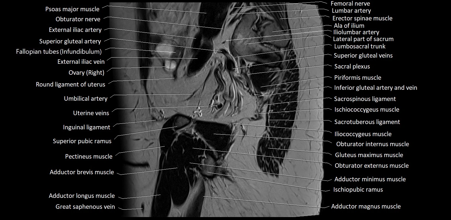 Sagittal cross sectional anatomy of female pelvis (MRI 3T) image 9.webp